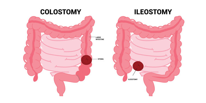 The ileum stoma abdomen Pouch for blocked poo stool system of Small Large Colon with Crohn and Hirschsprung disease inflammation Surgery hernia Cancer tract Rectal Tumor Loop invasive removal