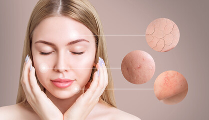 Magnifying circles shows skin problems of young woman.