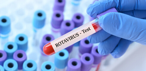 Obraz premium Doctor holding a test blood sample tube with Rota virus test on the background of medical test tubes with analyzes.