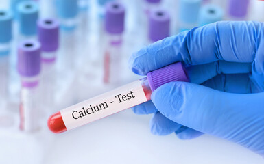 Doctor holding a test blood sample tube with calcium test on the background of medical test tubes...