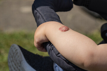Skin tumor on the hand of a small child.