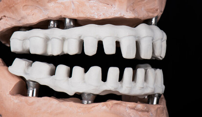 Emax ceramics on hybrid implant bridge