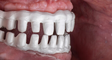 Emax ceramics on hybrid implant bridge