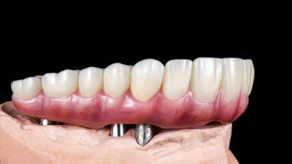 Emax ceramics on hybrid implant bridge