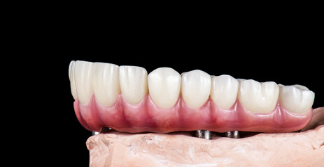Emax ceramics on hybrid implant bridge