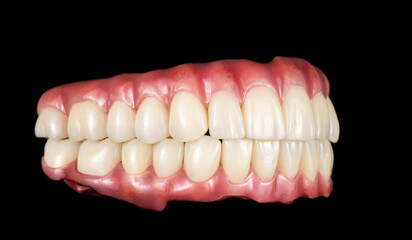Emax ceramics on hybrid implant bridge