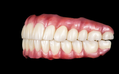 Emax ceramics on hybrid implant bridge