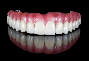 Emax ceramics on hybrid implant bridge