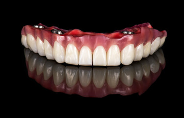 Emax ceramics on hybrid implant bridge