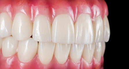Emax ceramics on hybrid implant bridge