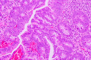 Backgrounds of human cells tissue of lung human under the microscope in pathology lab.View in microscopic of ductal cell carcinoma, adenonocarcinoma from cancer, tissue section by H and E stain.