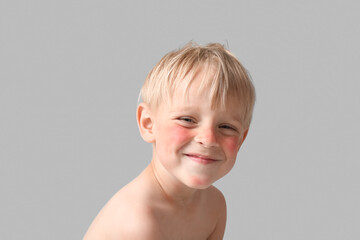 Allergic little boy with sunburned face on grey background, closeup
