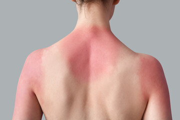 Allergic young woman with sunburned skin on grey background, back view