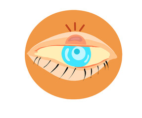 illustration vector, Human eye with swelled eyelid. Blepharitis.