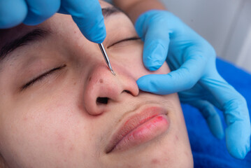 An esthetician uses a comedone extractor to dislodge blackheads from a patient's nose. Facial procedure and treatment or preparation for rhinoplasty.