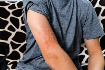 Skin rash and swelling on man arm, immunizations prevent infectious disease in human