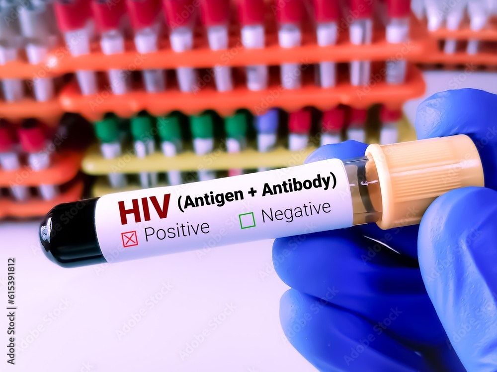 Poster blood sample in a tube with label hiv (antigen + antibody) test.