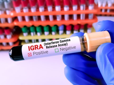 Blood sample for IGRA (Interferon gamma release assay) test.