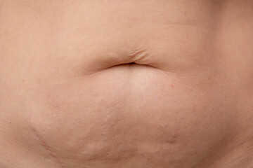 Post-pregnancy belly button altered due to an umbilical hernia or stretched skin overhanging belly...