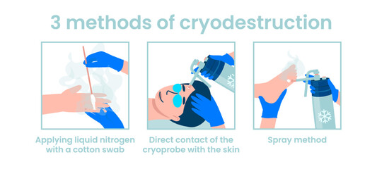 Methods of cryodestruction. Application of liquid nitrogen with a cotton swab. Direct contact of the cryoprobe with the skin. Spray method. Flat vector illustration.