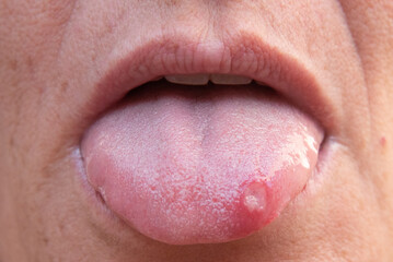 canker sore on a person's tongue, upset stomach