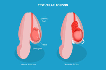 3D Isometric Flat Vector Conceptual Illustration of Testicular Torison, Male Reproductive System Disorder