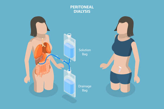 3D Isometric Flat Vector Conceptual Illustration of Peritoneal Dialysis, Explanation Diagram