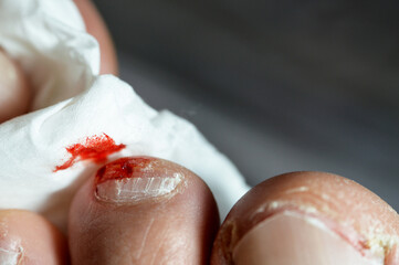 Bleeding on the tip of the second toe of the left foot, insult of the foot toe resulting in a...