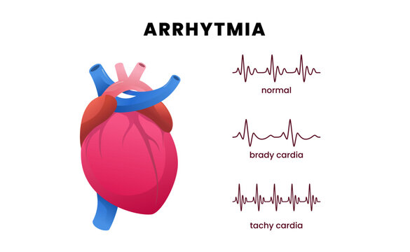 Cardiac disease arrhythmia with a heart and pulse ECG, showcasing normal heart rhythm, bradycardia or slow heart rate, and tachycardia or fast heart rate