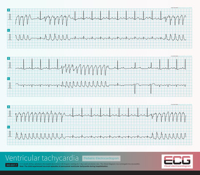 An 11 month old male infant was clinically diagnosed with cytomegalovirus myocarditis. The child repeatedly experienced ventricular tachycardia during hospitalization.