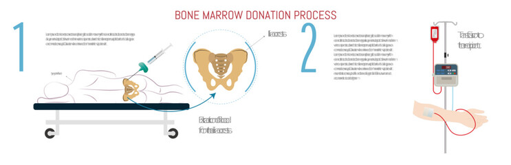 Process of bone marrow transplantation by means of an iliac crest puncture. - obrazy, fototapety, plakaty