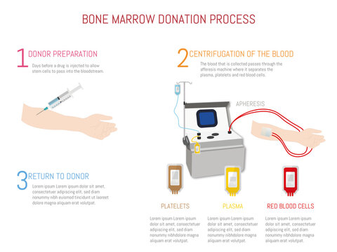 Process of bone marrow transplantation by means of apheresis
