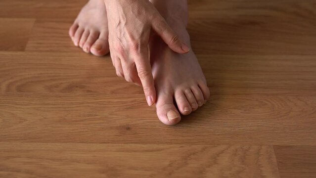 Hallux valgus on female legs on the background of laminate flooring. A bump on a woman's legs close-up. View from above.