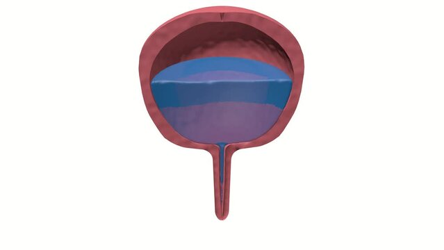 Normal prostate and acute prostatitis. Medical footage. Prostate with liquid in the cut