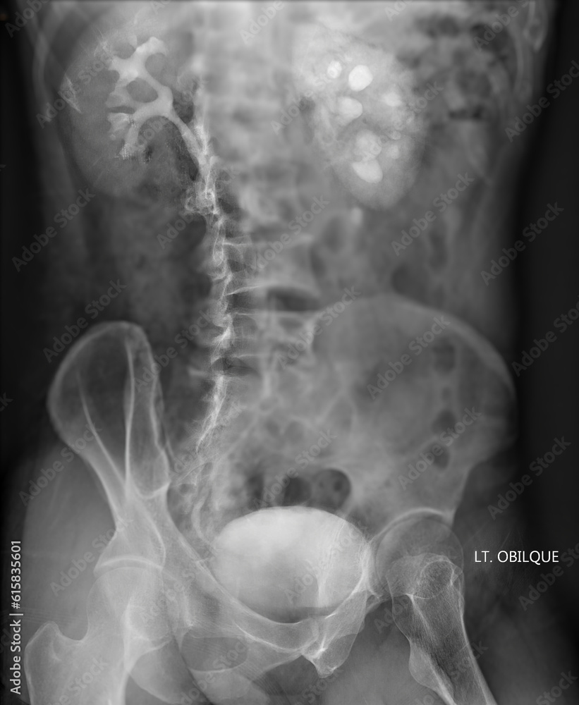 Poster intravenous pyelogram or i.v.p is an x-ray exam of urinary tract after injection contrast media agen