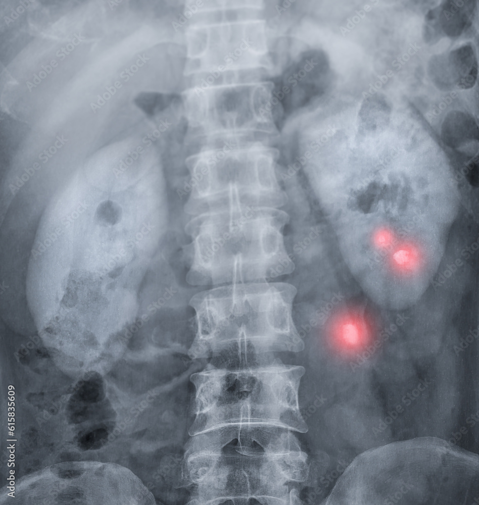 Aufkleber intravenous pyelogram or i.v.p is an x-ray exam of urinary tract after injection contrast media agen