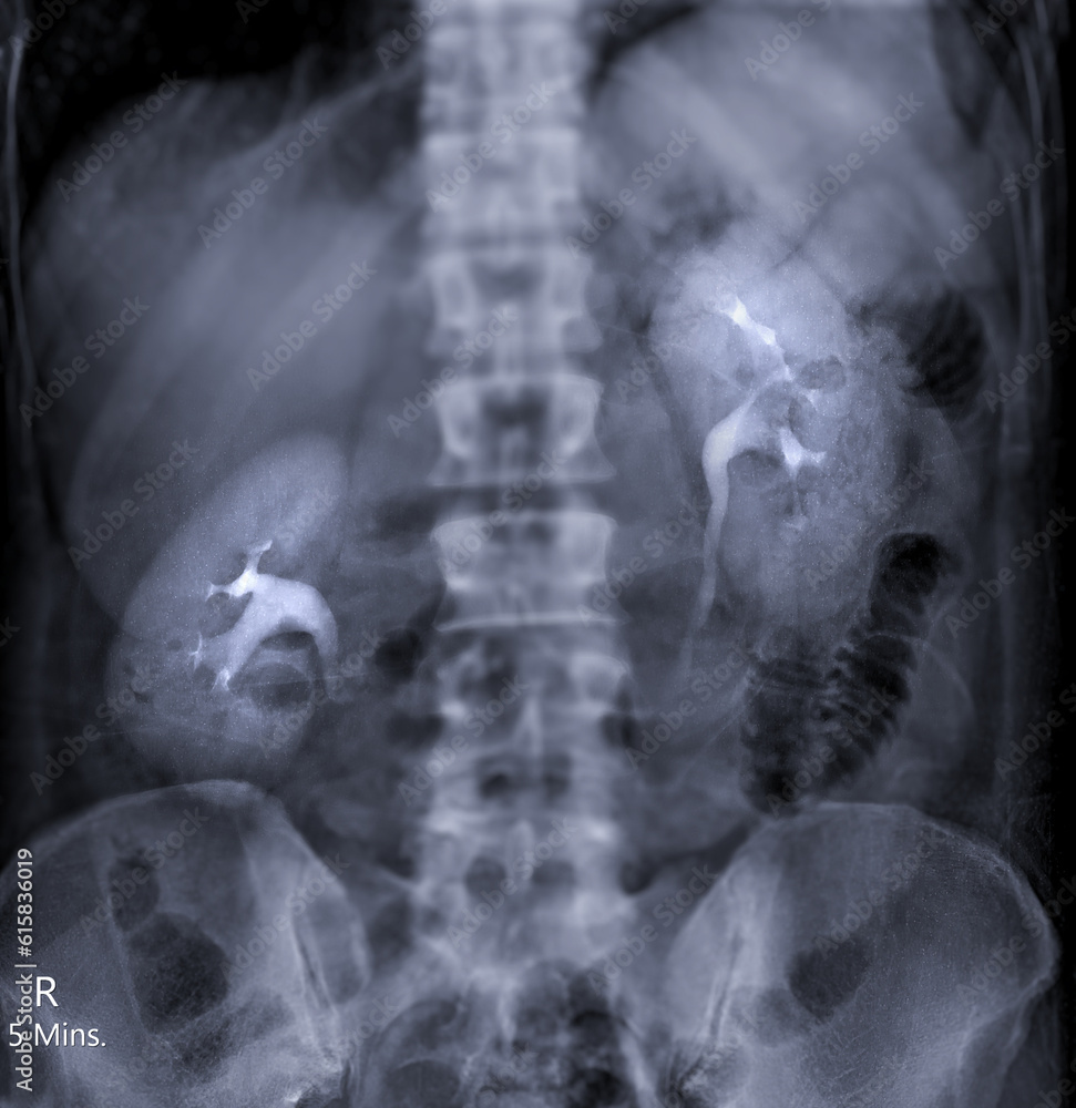 Poster intravenous pyelogram or i.v.p is an x-ray exam of urinary tract after injection contrast media agen