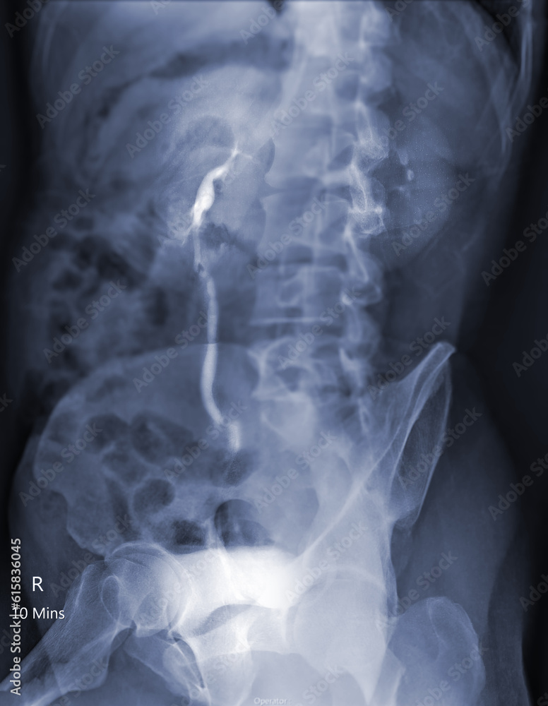 Poster intravenous pyelogram or i.v.p is an x-ray exam of urinary tract after injection contrast media agen