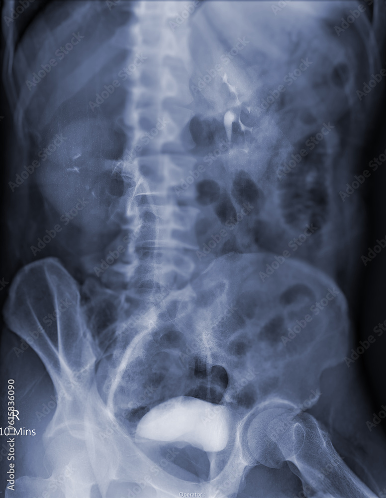Poster intravenous pyelogram or i.v.p is an x-ray exam of urinary tract after injection contrast media agen