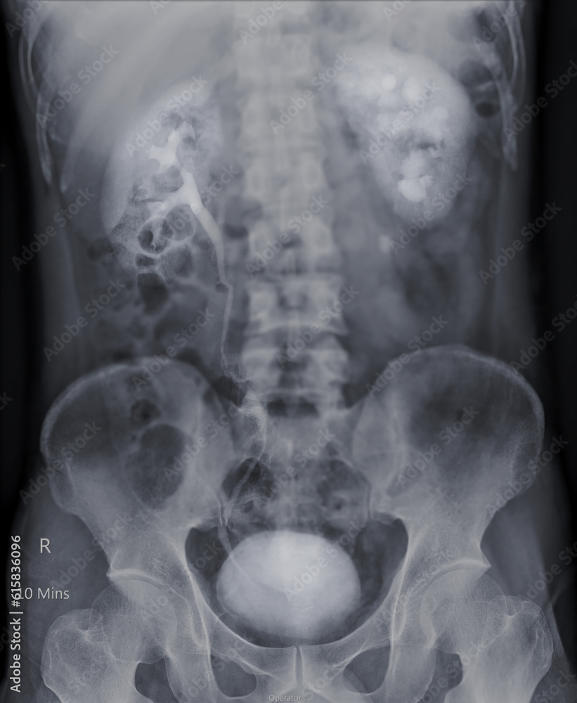 Poster intravenous pyelogram or i.v.p is an x-ray exam of urinary tract after injection contrast media agen