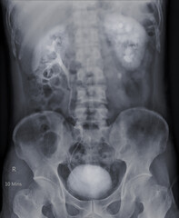  Intravenous pyelogram or I.V.P is an X-ray exam of urinary tract after injection contrast media agent  .