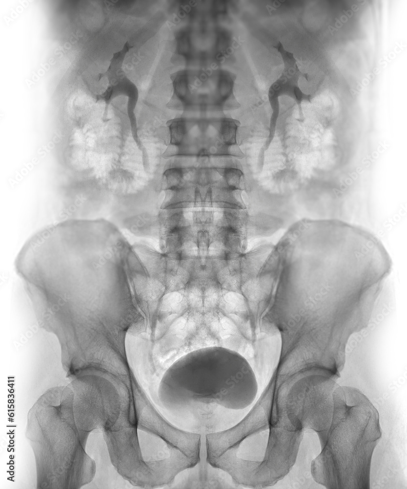 Poster intravenous pyelogram or i.v.p is an x-ray exam of urinary tract after injection contrast media agen