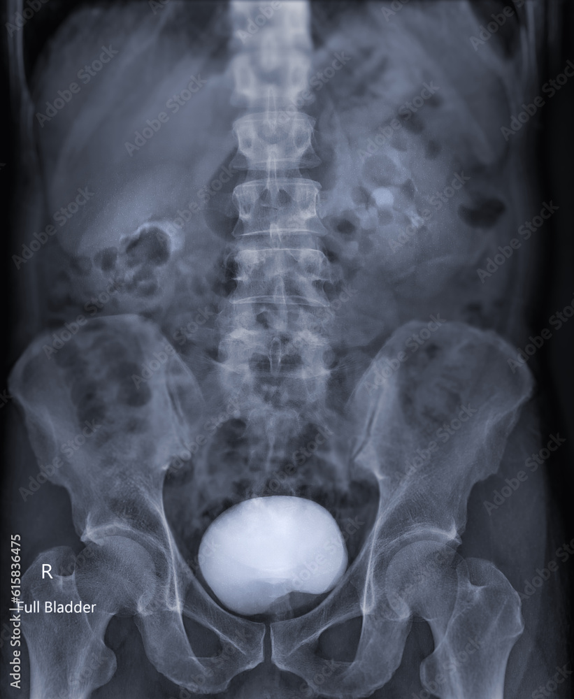 Poster intravenous pyelogram or i.v.p is an x-ray exam of urinary tract after injection contrast media agen