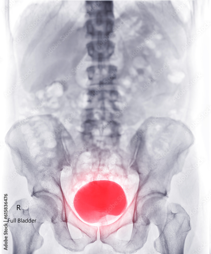 Poster intravenous pyelogram or i.v.p is an x-ray exam of urinary tract after injection contrast media agen