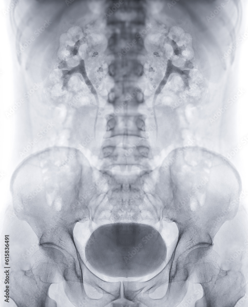 Aufkleber intravenous pyelogram or i.v.p is an x-ray exam of urinary tract after injection contrast media agen