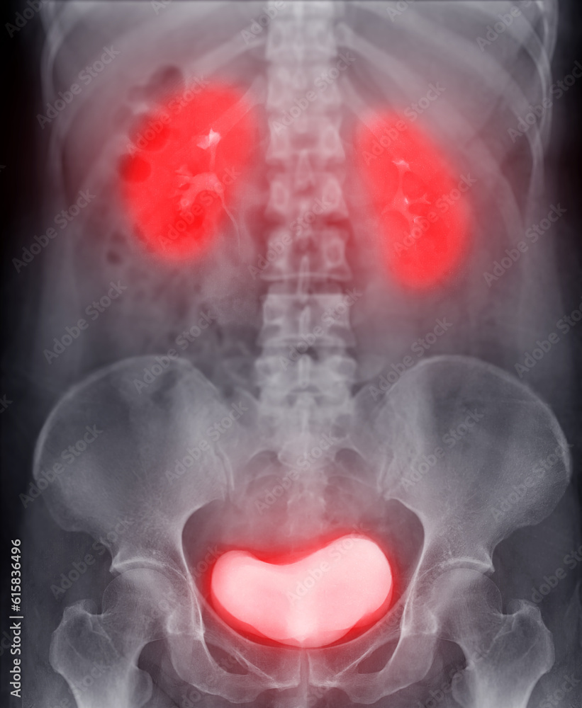 Poster intravenous pyelogram or i.v.p is an x-ray exam of urinary tract after injection contrast media agen