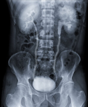  Intravenous pyelogram or I.V.P is an X-ray exam of urinary tract after injection contrast media agent  .