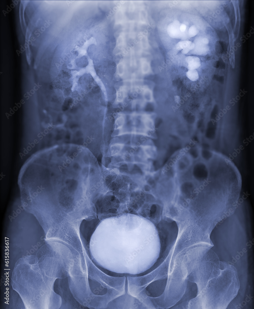 Poster intravenous pyelogram or i.v.p is an x-ray exam of urinary tract after injection contrast media agen