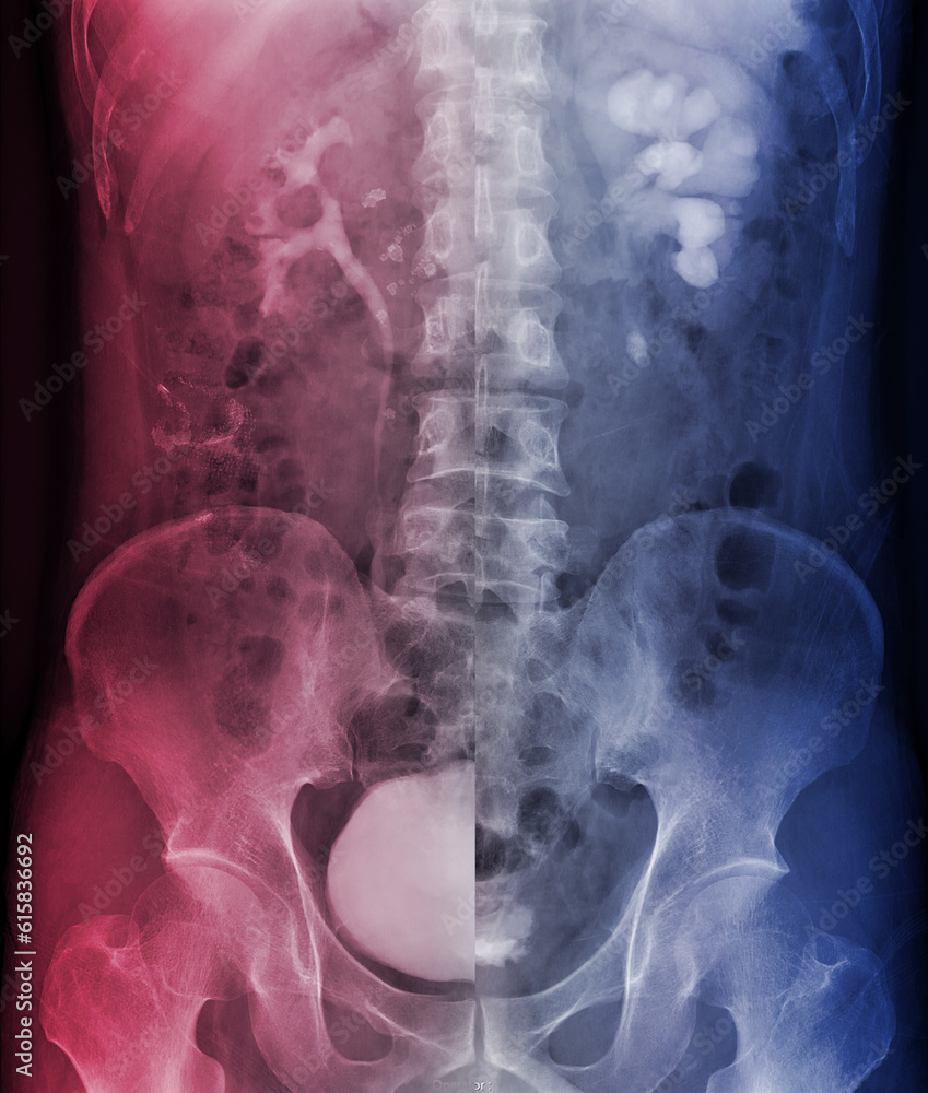 Aufkleber intravenous pyelogram or i.v.p is an x-ray exam of urinary tract after injection contrast media agen