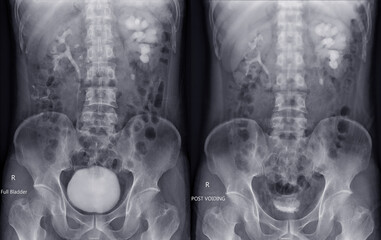  Intravenous pyelogram or I.V.P is an X-ray exam of urinary tract after injection contrast media agent  compare full bladder and post void. - obrazy, fototapety, plakaty